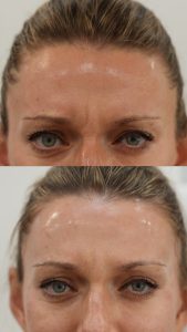 Botox Before and After Treatment Picture