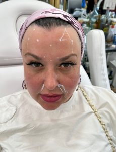 Nasolabial Fold Filler - Before Picture