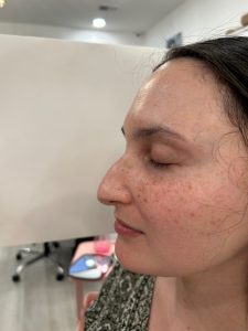 Non Surgical Rhinoplasty - Before Picture