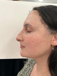 Non Surgical Rhinoplasty - After Picture