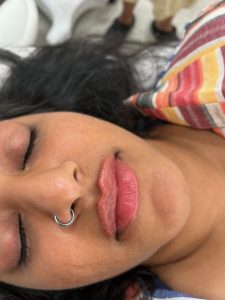 Lip Filler- After Picture