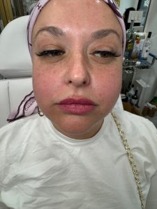 Nasolabial Fold Filler - After Picture